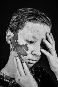 学生が医療脱毛でできた色素沈着の対処法は？